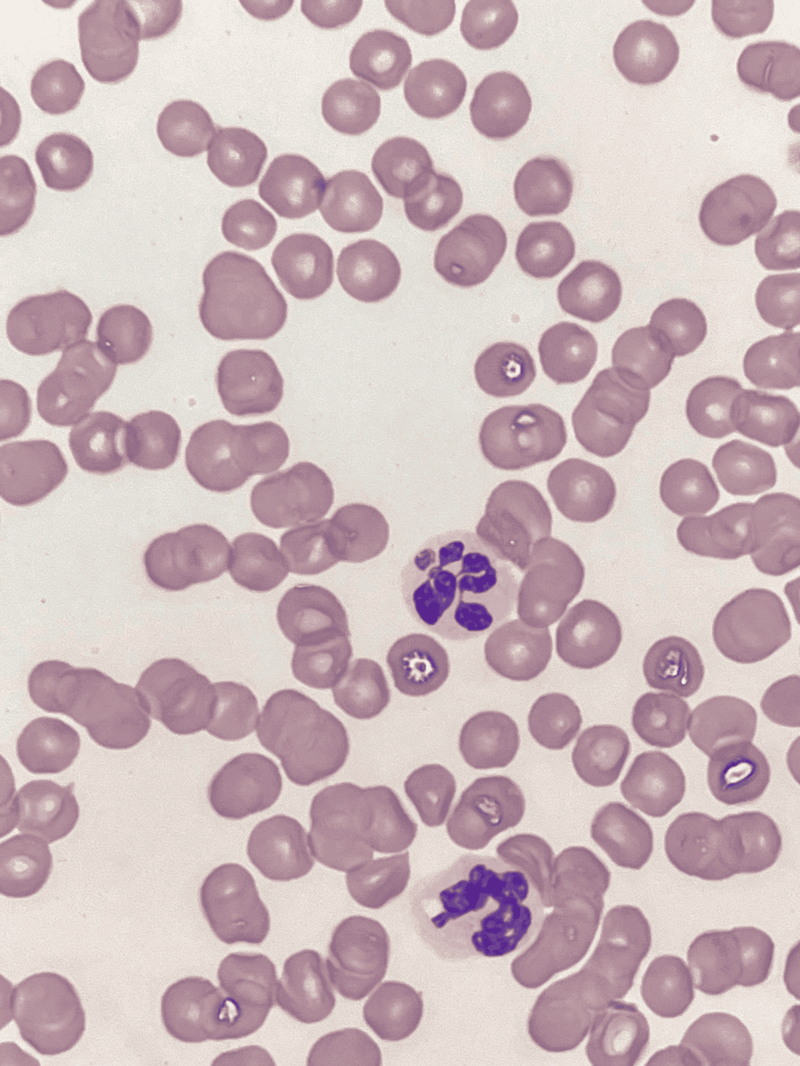 Microscopic image of cancer cells with purple stained nuclei, highlighting cellular abnormalities.