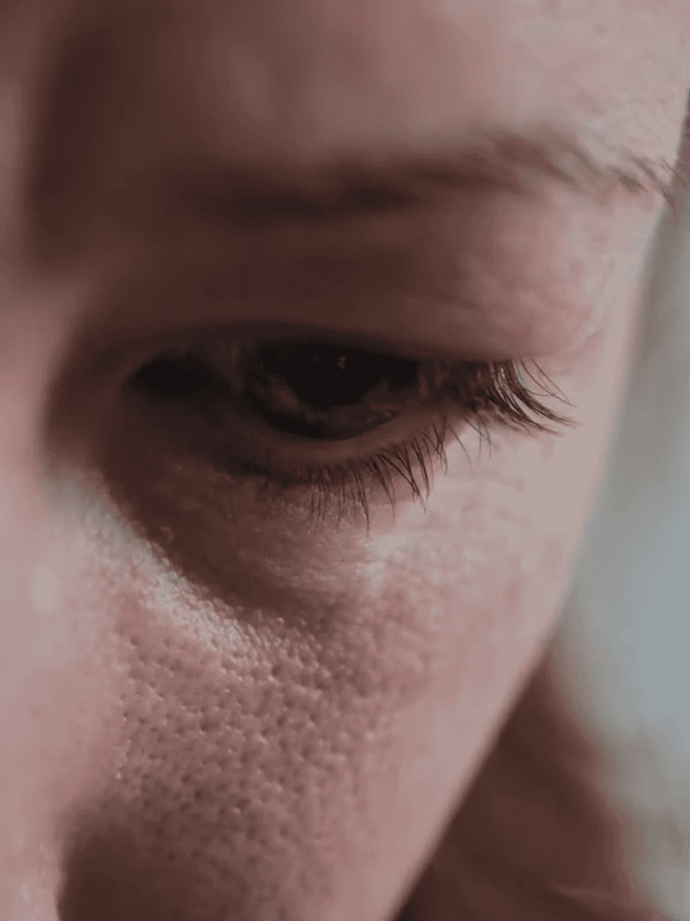 Close-up of dry, flaky skin around the eye area.